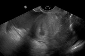 3 uterus w pseudosac.jpg